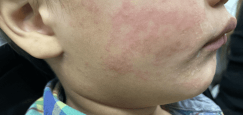 measles continues raging in south carolina 99