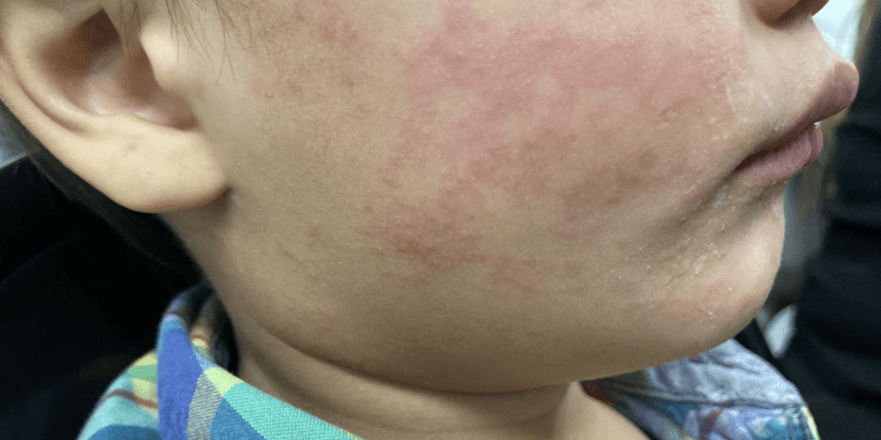 Measles continues raging in South Carolina; 99 new cases since Tuesday 19 measles continues raging in south carolina 99