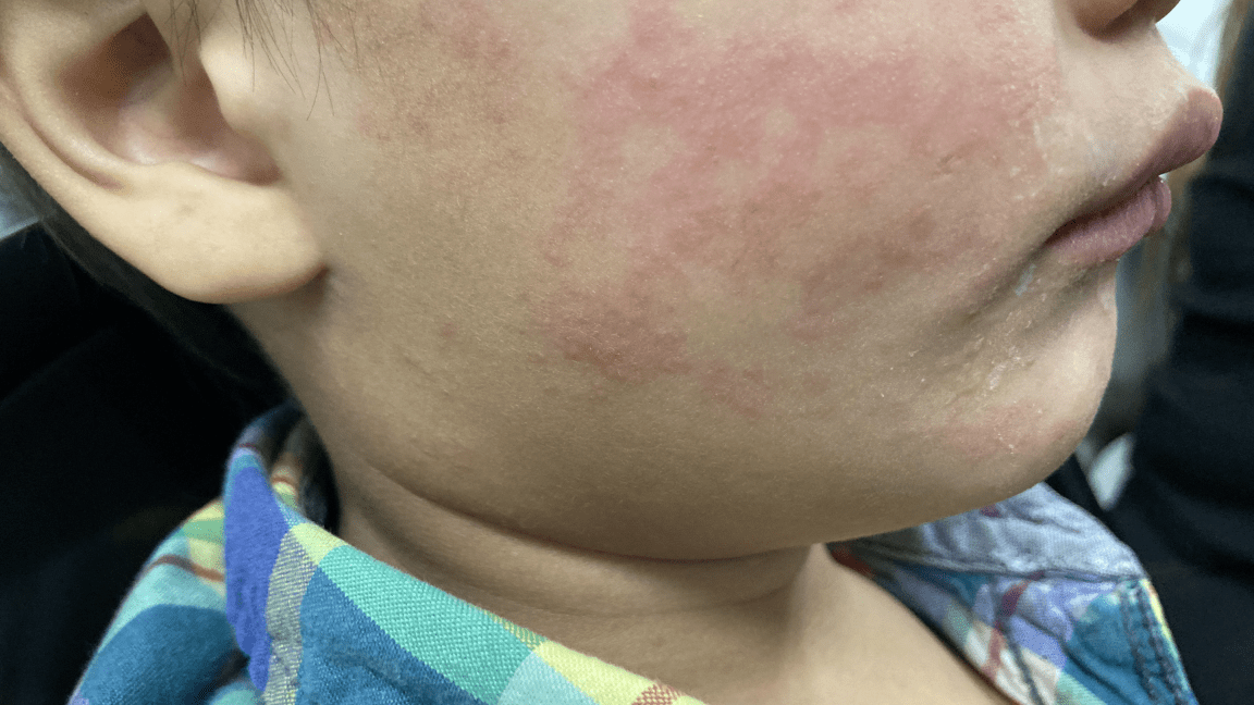 measles continues raging in south carolina 99