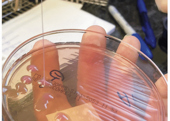 this may be the grossest eye pic