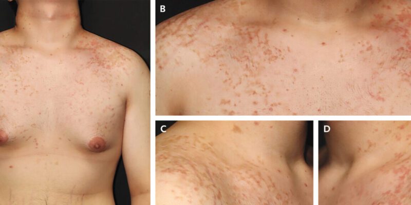 A weird, itchy rash is linked to the keto diet—but no one knows why 3 a weird itchy rash is linked to