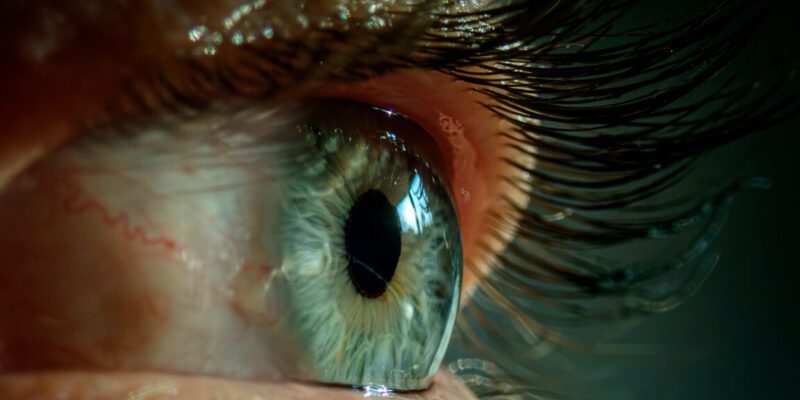 Bad sleep made woman's eyelids so floppy they flipped inside out, got stuck 18 bad sleep made woman s eyelids so