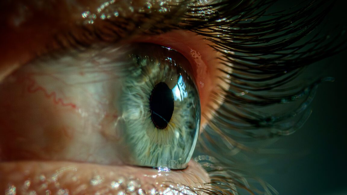 bad sleep made woman s eyelids so