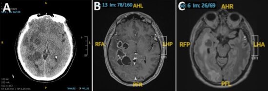 doctors suspected man had brain cancer he