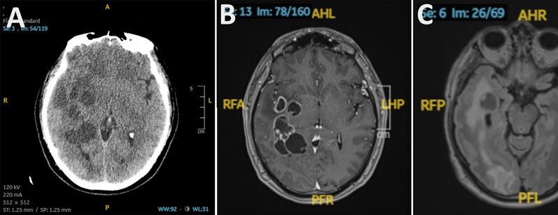 Doctors suspected man had brain cancer. He actually had worms. 6 doctors suspected man had brain cancer he