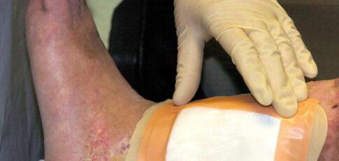 second carcass-eating fly species cleared by fda