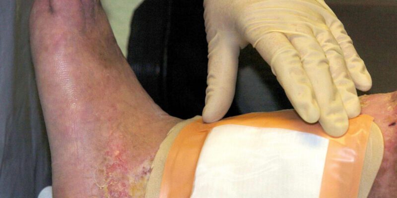 Second carcass-eating fly species cleared by FDA for maggot wound therapy 4 second carcass-eating fly species cleared by fda