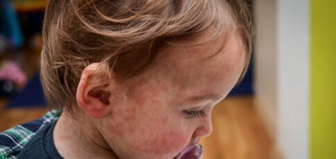 child dies of horrifying measles complication in