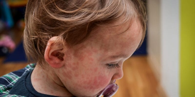 Child dies of horrifying measles complication in Los Angeles 11 child dies of horrifying measles complication in