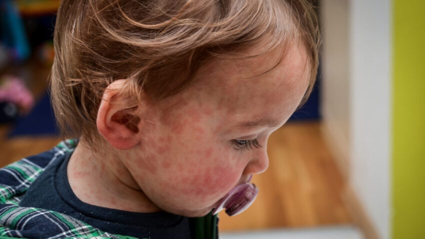 child dies of horrifying measles complication in