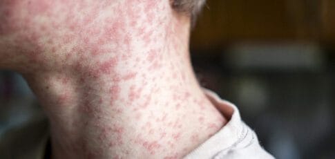 measles outbreak in sc sends 150 unvaccinated