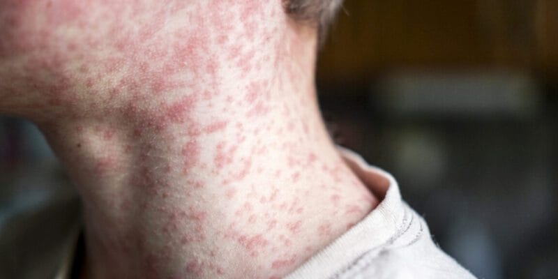Measles outbreak in SC sends 150 unvaccinated kids into 21-day quarantine 1 measles outbreak in sc sends 150 unvaccinated