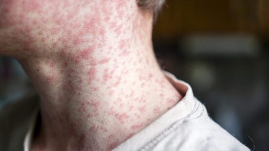 measles outbreak investigation in utah blocked by
