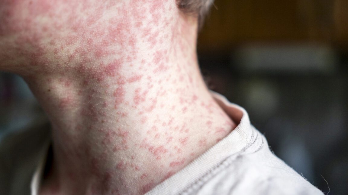 measles outbreak investigation in utah blocked by