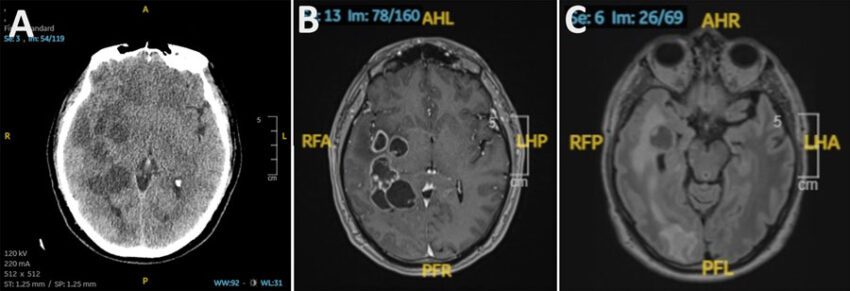 doctors suspected man had brain cancer he